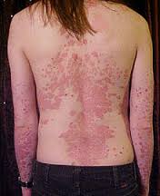 Triệu chứng và cách điều trị bệnh vẩy nến